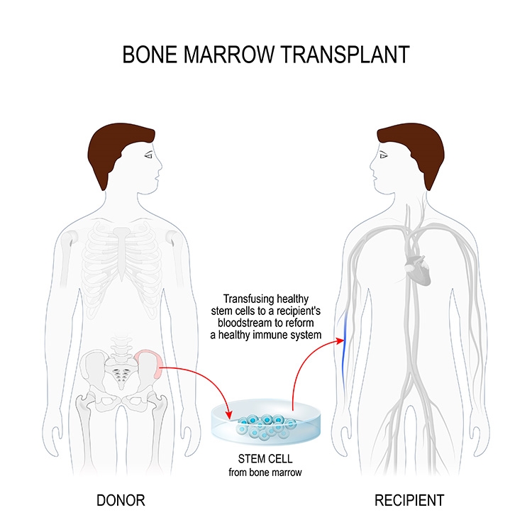 Stem cells collected from bone marrow have the power to cure blood cancer, sickle cell disease, and inherited immune disorders.