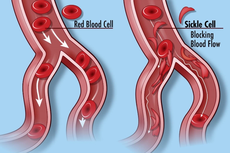 How sickle cell disease blocks blood flow and causes painful crises and organ damage in patients.