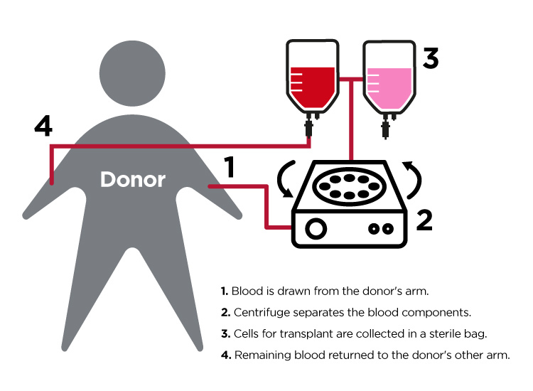 Diagram illustrating the apheresis process, where blood is drawn from one arm, the stem cells are collected by the apheresis machine, and the remaining blood is returned to the donor's other arm. Donors have the potential to save the lives of those battling leukemia, lymphoma, sickle cell, and dozens of other deadly diseases.