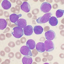 Leukemia blasts are stained purple in this image showing both normal blood cells and blasts. Image of leukemia blasts CC BY-SA 3.0 By VashiDonsk at English Wikipedia. 